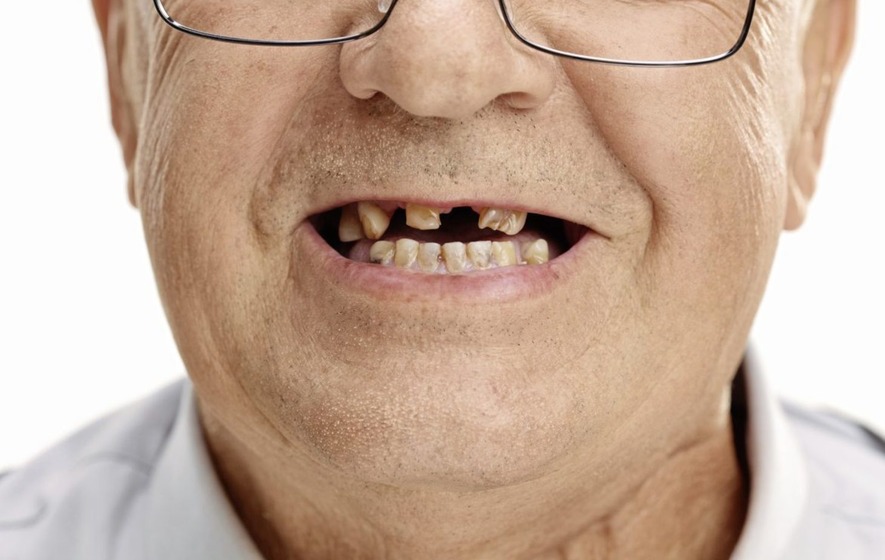 Bác sĩ khuyến cáo, khi mất răng nên phục hồi răng sớm để ngăn ngừa những bệnh lý do mất răng gây ra (ảnh minh họa)