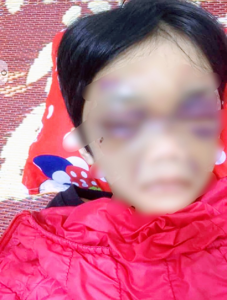 Hải Dương: Bé gái 6 tuổi bị mẹ đẻ bạo hành thâm tím mặt  - Ảnh 1.